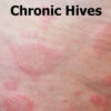 Chronic-Hives