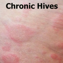 Chronic Hives